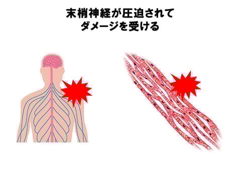 抹消神経が圧迫されてダメージを受ける