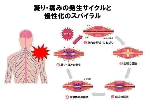 慢性化のスパイラル