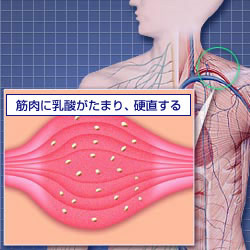 急性的な肩こり｜肩こり・腰痛原因チェック｜エーザイ株式会社