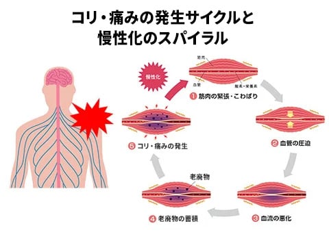 img_spiral_of_stiffness_and_pain