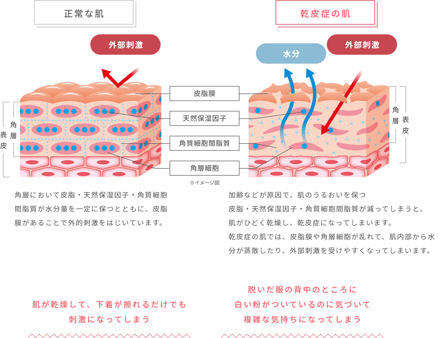 正常な肌:角層において皮脂・天然保湿因子・角質細胞間脂質が水分量を一定に保つとともに、皮脂膜があることで外的刺激をはじいています。乾皮症の肌:加齢などが原因で、肌のうるおいを保つ皮脂・天然保湿因子・角質細胞間脂質が減ってしまうと、肌がひどく乾燥し、乾皮症になってしまいます。乾皮症の肌では、皮脂膜や角層細胞が乱れて、肌内部から水分が蒸散したり、外部刺激を受けやすくなってしまいます。 肌が乾燥して、下着が擦れるだけでも刺激になってしまう 脱いだ服の背中のところに白い粉がついているのに気づいて複雑な気持ちになってしまう