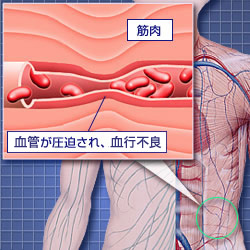 慢性的な腰痛 肩こり 腰痛原因チェック エーザイ株式会社