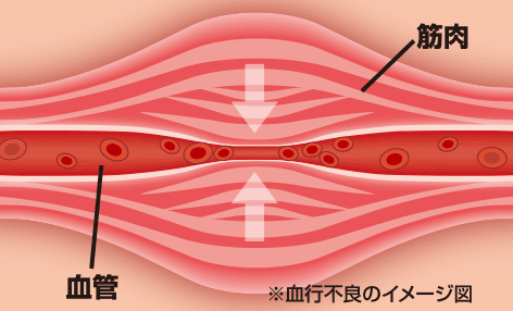 血行不良のイメージ図