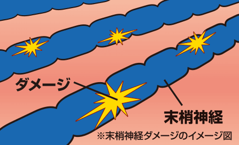 末梢神経ダメージのイメージ図